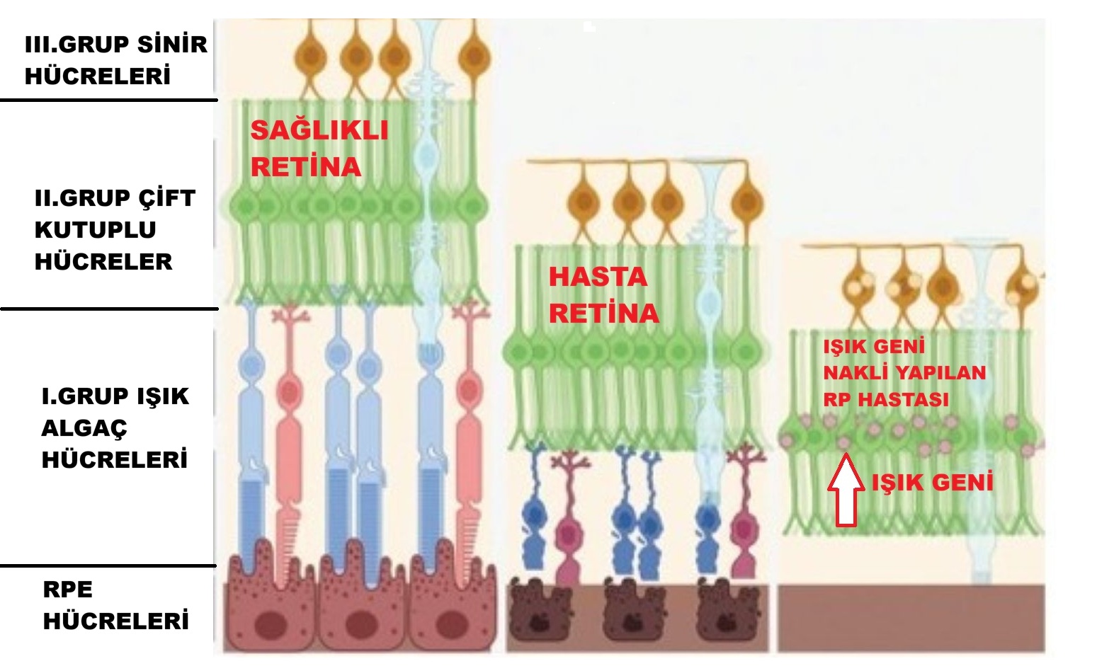 Optogenetik tedavi şeması